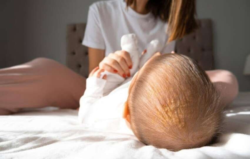 Things New Moms Should Know About Cradle Cap In Babies